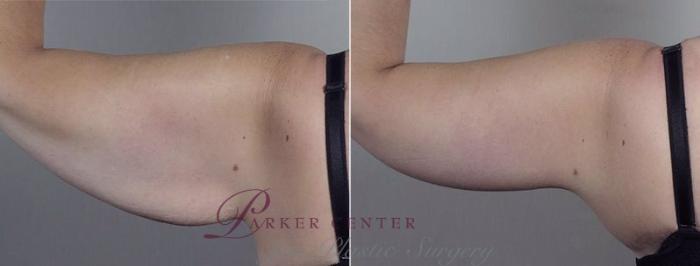 Upper Arm Rejuvenation Case 749 Before & After View #6 | Paramus, NJ | Parker Center for Plastic Surgery
