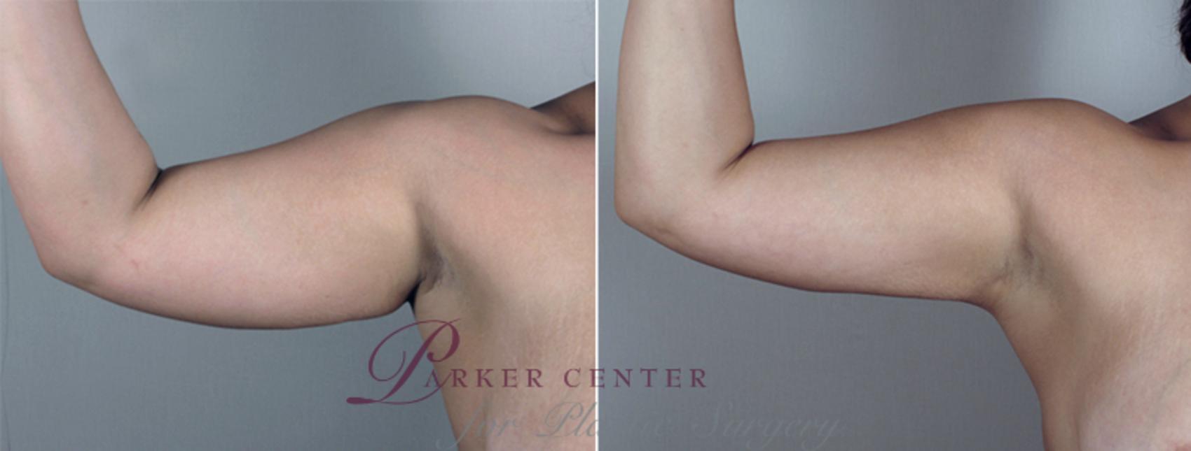 Upper Arm Rejuvenation Case 776 Before & After View #4 | Paramus, NJ | Parker Center for Plastic Surgery