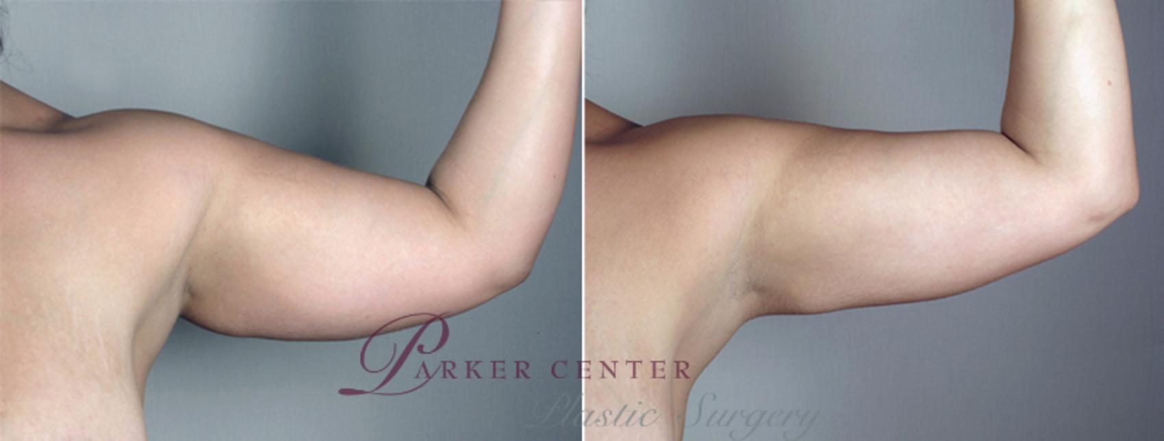 Upper Arm Rejuvenation Case 776 Before & After View #5 | Paramus, NJ | Parker Center for Plastic Surgery