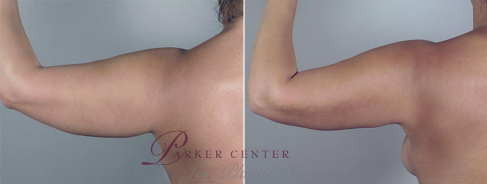 Upper Arm Rejuvenation Case 776 Before & After View #6 | Paramus, NJ | Parker Center for Plastic Surgery