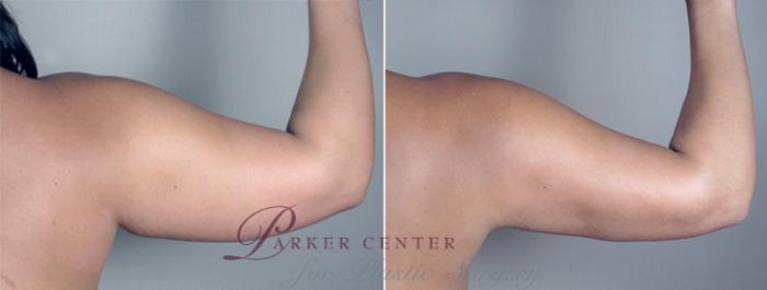 Upper Arm Rejuvenation Case 776 Before & After View #7 | Paramus, NJ | Parker Center for Plastic Surgery