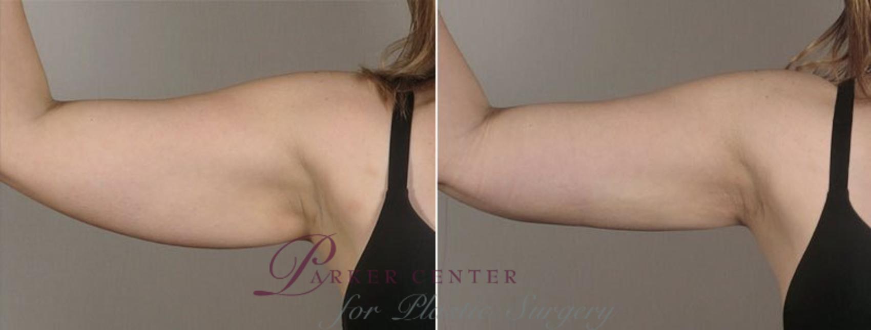 Upper Arm Rejuvenation Case 803 Before & After View #1 | Paramus, NJ | Parker Center for Plastic Surgery