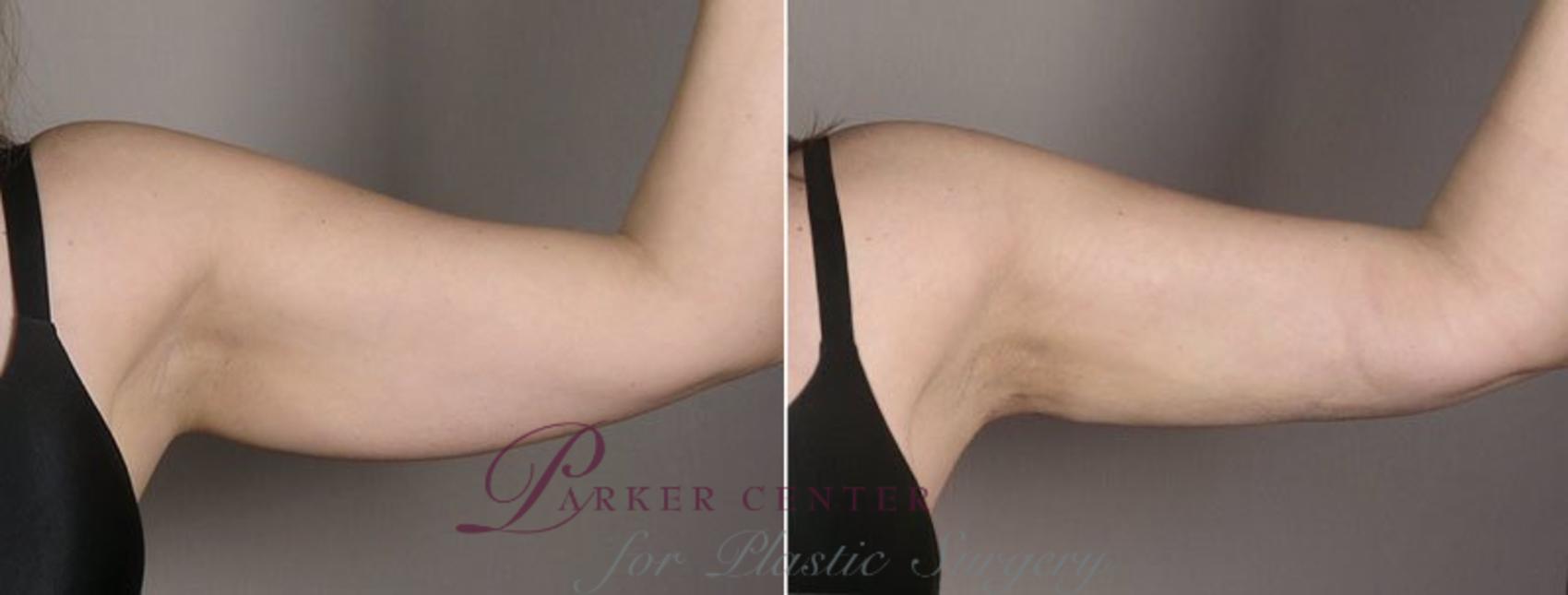 Upper Arm Rejuvenation Case 803 Before & After View #2 | Paramus, NJ | Parker Center for Plastic Surgery