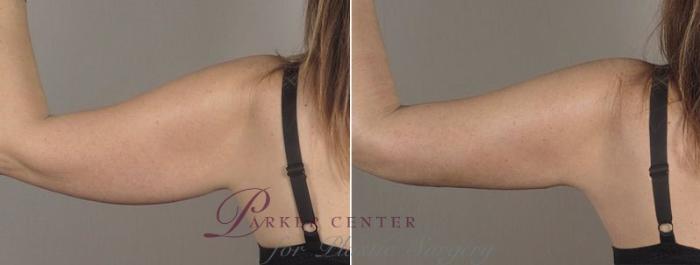 Upper Arm Rejuvenation Case 803 Before & After View #3 | Paramus, NJ | Parker Center for Plastic Surgery