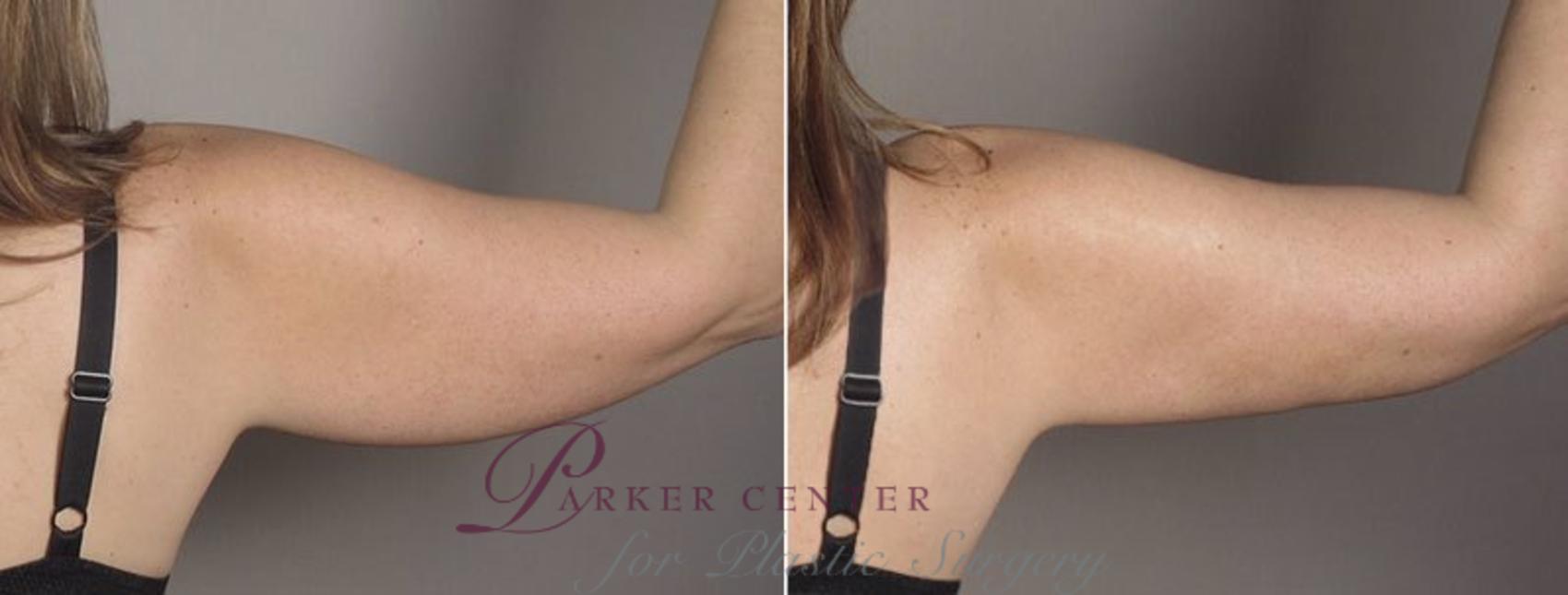 Upper Arm Rejuvenation Case 803 Before & After View #4 | Paramus, NJ | Parker Center for Plastic Surgery