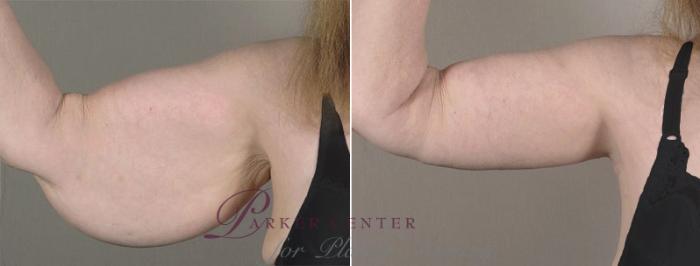 Upper Arm Rejuvenation Case 821 Before & After View #1 | Paramus, NJ | Parker Center for Plastic Surgery
