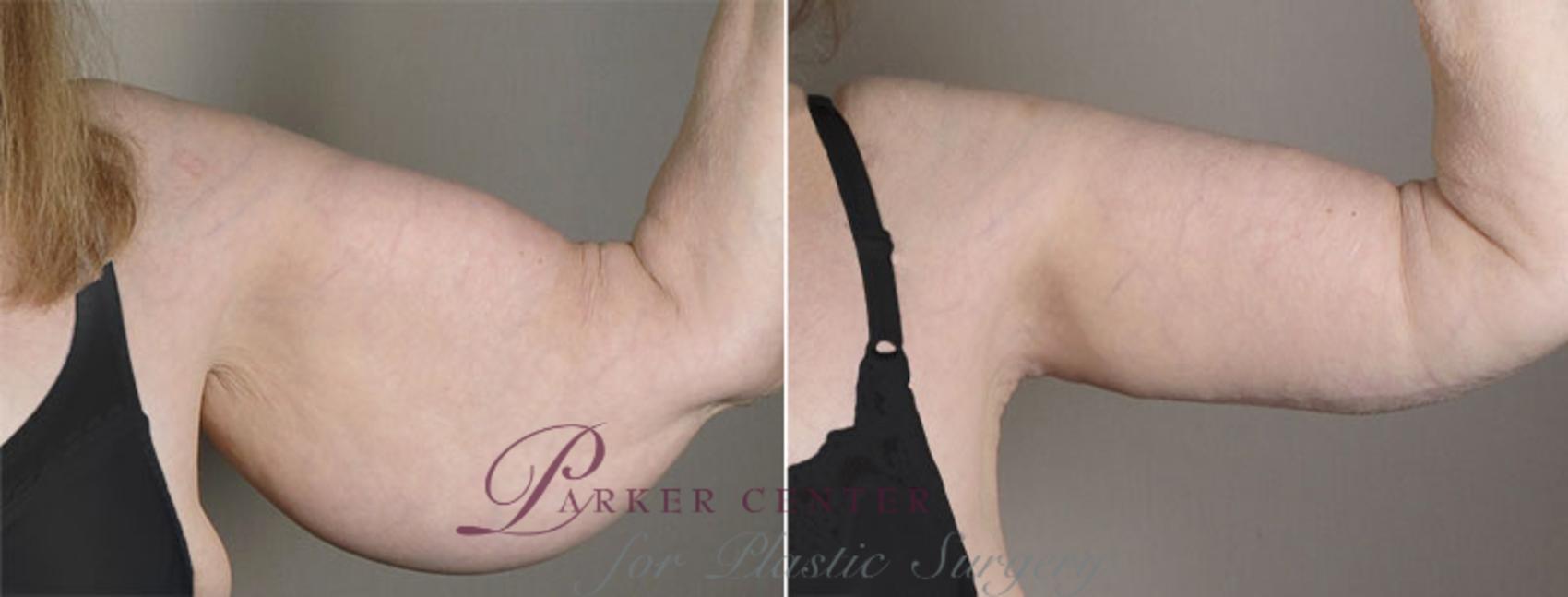 Upper Arm Rejuvenation Case 821 Before & After View #2 | Paramus, NJ | Parker Center for Plastic Surgery