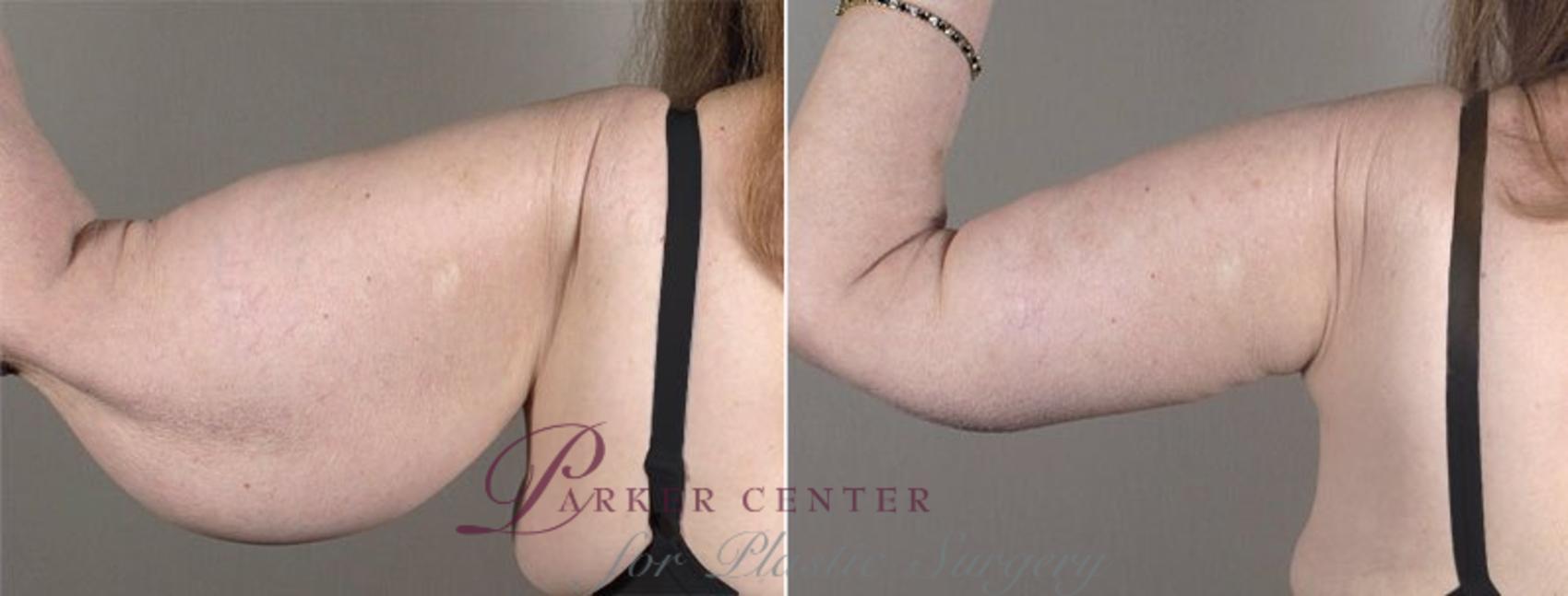 Upper Arm Rejuvenation Case 821 Before & After View #3 | Paramus, New Jersey | Parker Center for Plastic Surgery