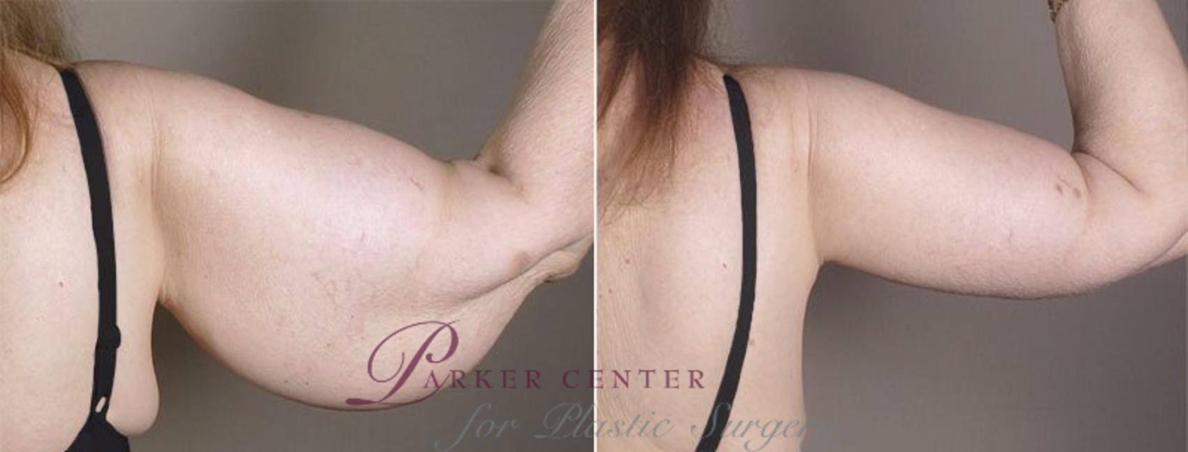 Upper Arm Rejuvenation Case 821 Before & After View #4 | Paramus, NJ | Parker Center for Plastic Surgery