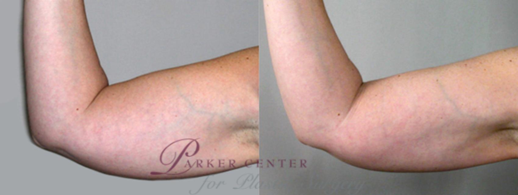Upper Arm Rejuvenation Case 822 Before & After View #1 | Paramus, NJ | Parker Center for Plastic Surgery
