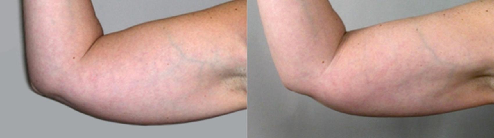 Upper Arm Rejuvenation Case 822 Before & After View #1 | Paramus, NJ | Parker Center for Plastic Surgery