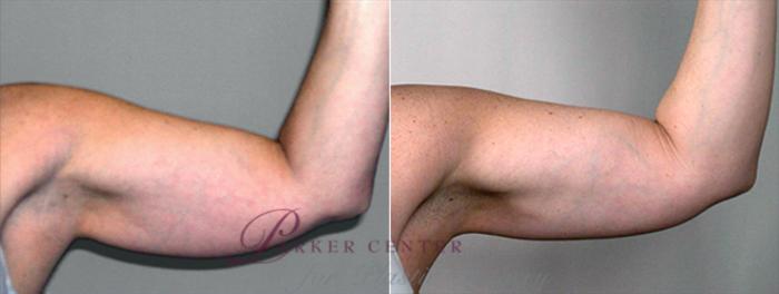 Upper Arm Rejuvenation Case 822 Before & After View #2 | Paramus, NJ | Parker Center for Plastic Surgery