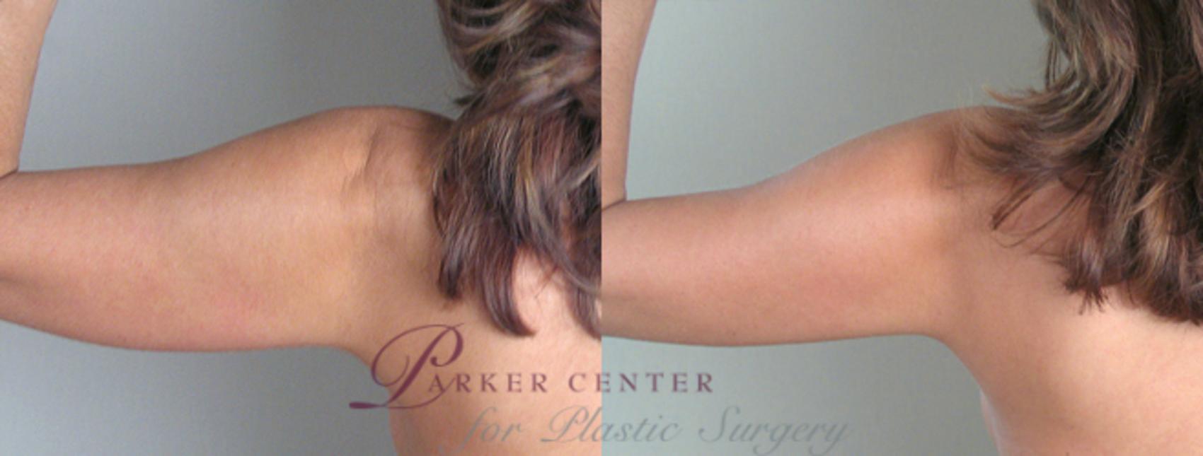 Upper Arm Rejuvenation Case 823 Before & After View #1 | Paramus, NJ | Parker Center for Plastic Surgery