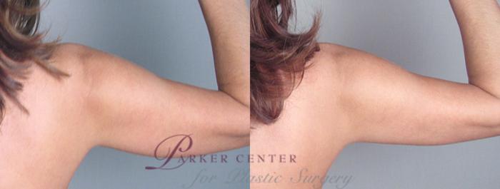 Upper Arm Rejuvenation Case 823 Before & After View #2 | Paramus, NJ | Parker Center for Plastic Surgery