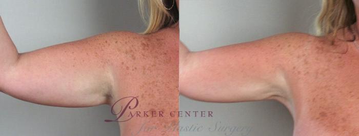 Upper Arm Rejuvenation Case 824 Before & After View #1 | Paramus, NJ | Parker Center for Plastic Surgery