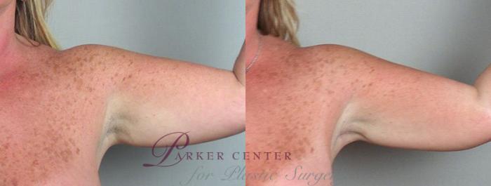 Upper Arm Rejuvenation Case 824 Before & After View #2 | Paramus, NJ | Parker Center for Plastic Surgery