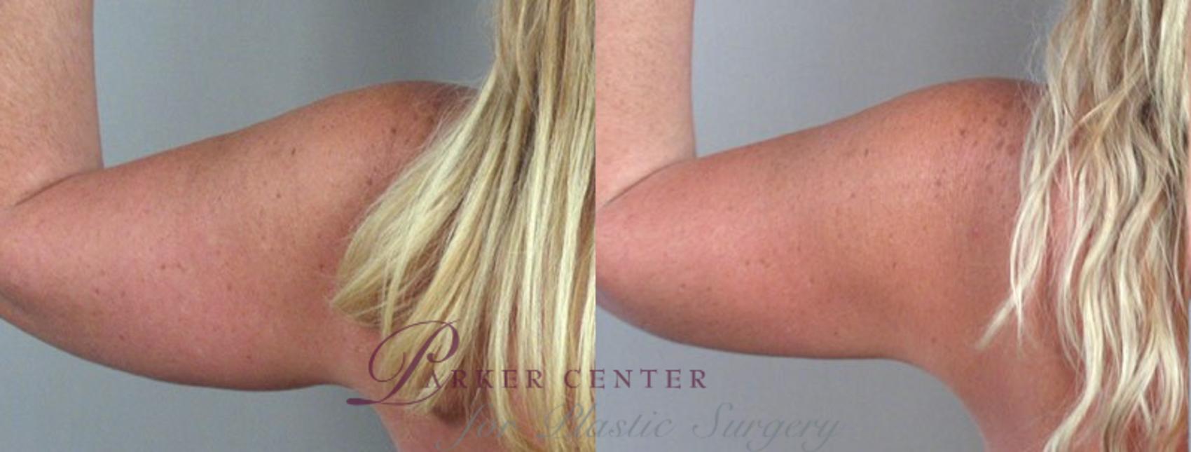 Upper Arm Rejuvenation Case 824 Before & After View #3 | Paramus, New Jersey | Parker Center for Plastic Surgery