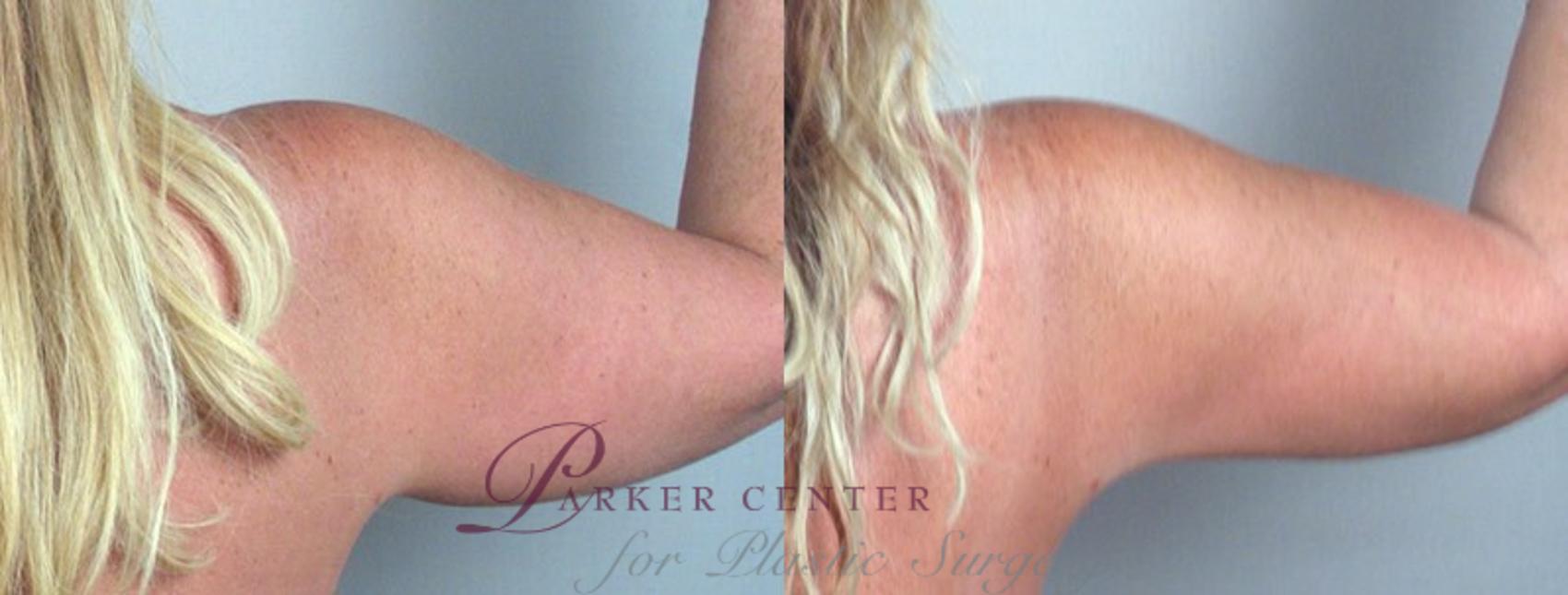 Upper Arm Rejuvenation Case 824 Before & After View #4 | Paramus, New Jersey | Parker Center for Plastic Surgery