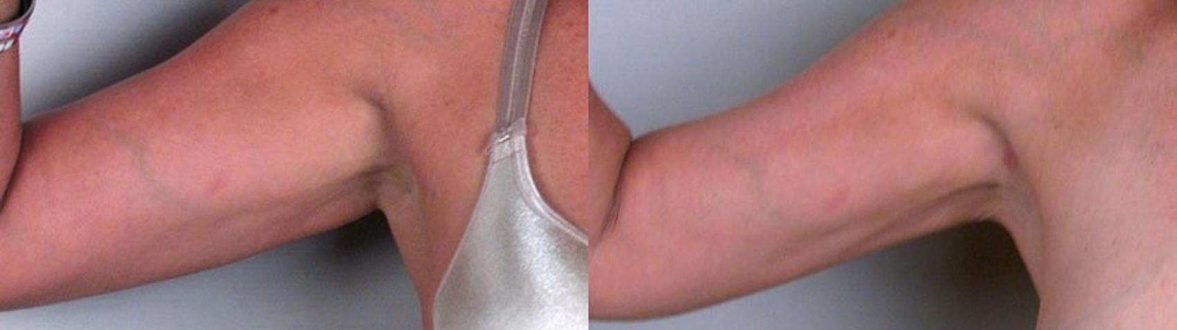 Upper Arm Rejuvenation Case 825 Before & After View #1 | Paramus, NJ | Parker Center for Plastic Surgery