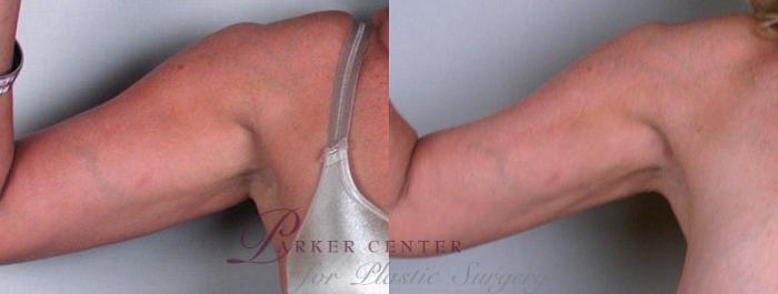 Upper Arm Rejuvenation Case 825 Before & After View #1 | Paramus, NJ | Parker Center for Plastic Surgery