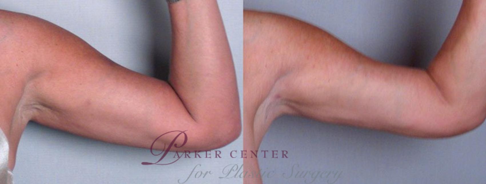 Upper Arm Rejuvenation Case 825 Before & After View #2 | Paramus, NJ | Parker Center for Plastic Surgery