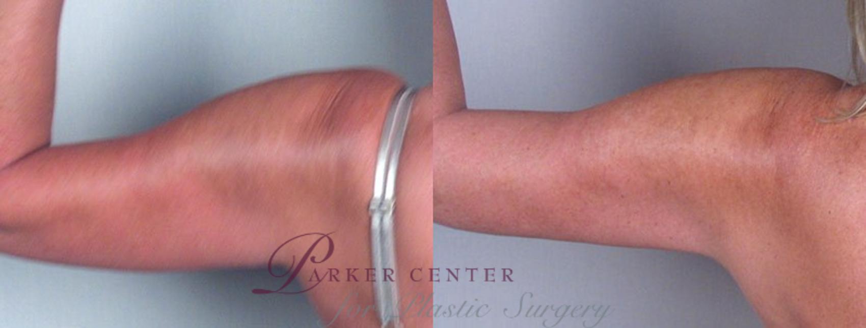 Upper Arm Rejuvenation Case 825 Before & After View #3 | Paramus, NJ | Parker Center for Plastic Surgery