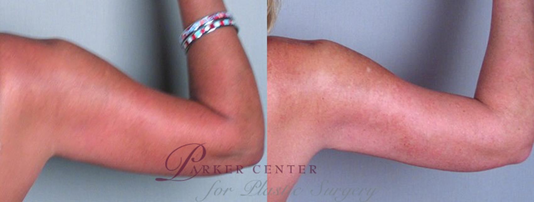Upper Arm Rejuvenation Case 825 Before & After View #4 | Paramus, NJ | Parker Center for Plastic Surgery