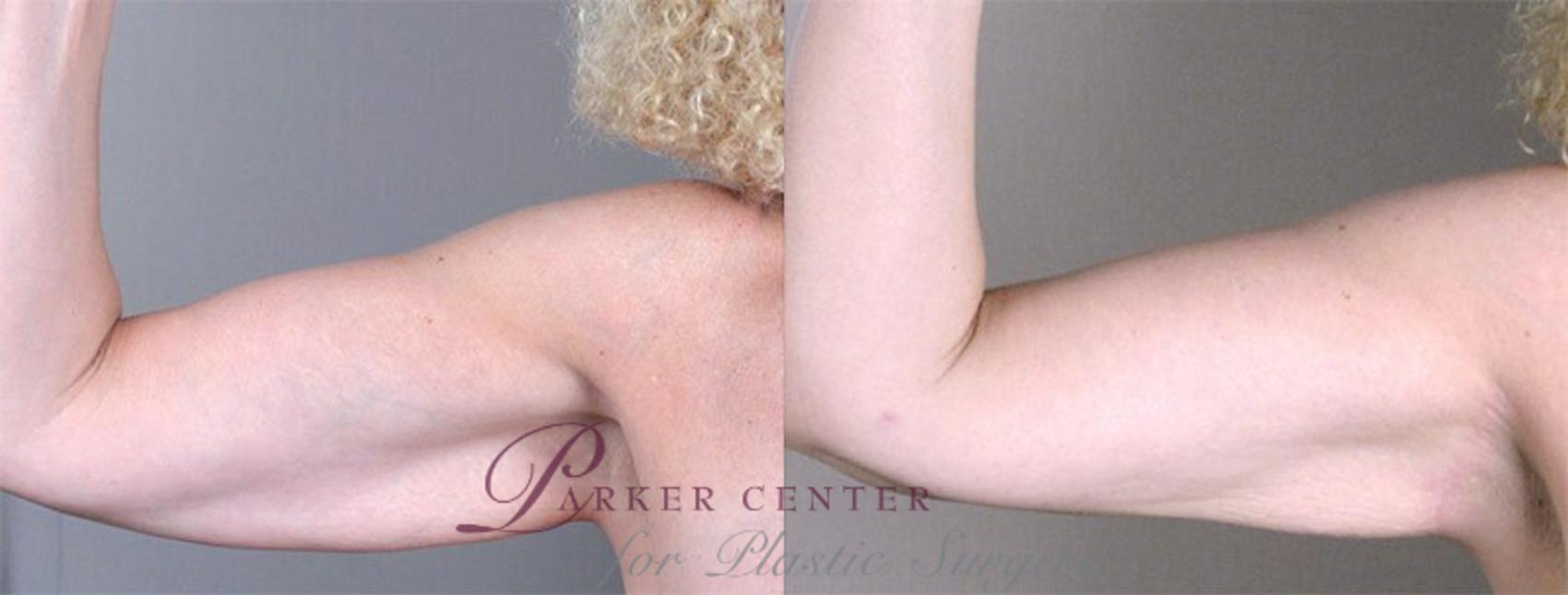 Upper Arm Rejuvenation Case 826 Before & After View #1 | Paramus, NJ | Parker Center for Plastic Surgery