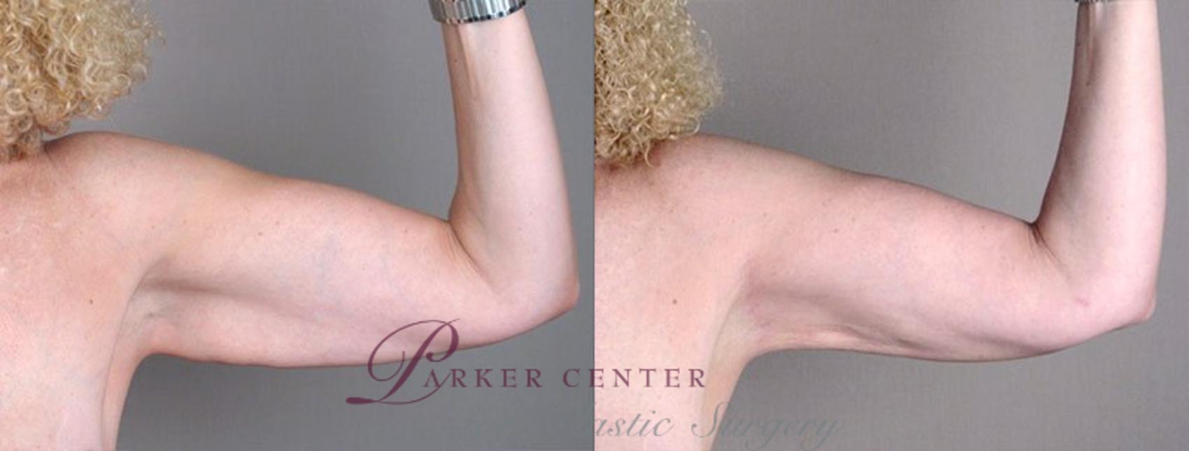 Upper Arm Rejuvenation Case 826 Before & After View #2 | Paramus, NJ | Parker Center for Plastic Surgery