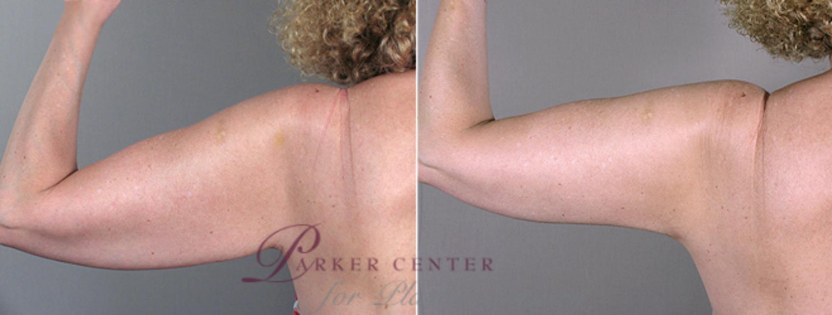 Upper Arm Rejuvenation Case 826 Before & After View #3 | Paramus, NJ | Parker Center for Plastic Surgery