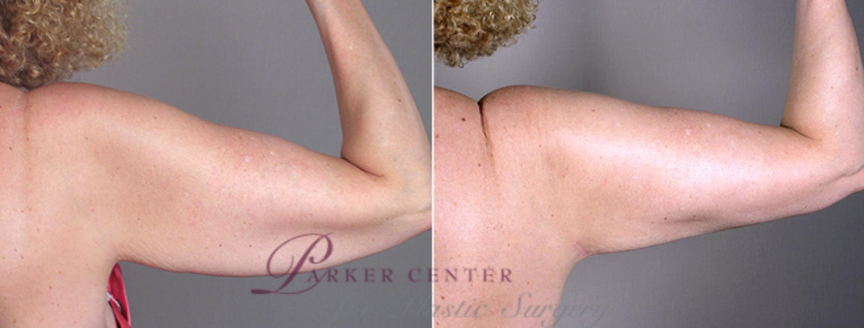 Upper Arm Rejuvenation Case 826 Before & After View #4 | Paramus, NJ | Parker Center for Plastic Surgery