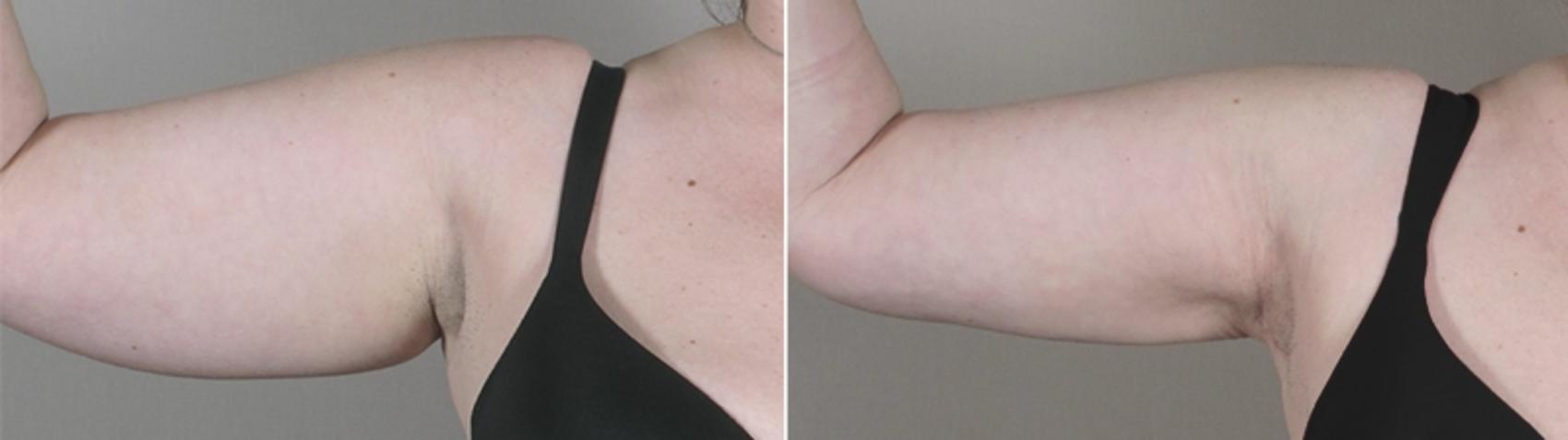 Upper Arm Rejuvenation Case 827 Before & After View #1 | Paramus, New Jersey | Parker Center for Plastic Surgery