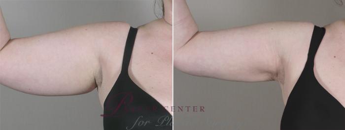 Upper Arm Rejuvenation Case 827 Before & After View #1 | Paramus, NJ | Parker Center for Plastic Surgery