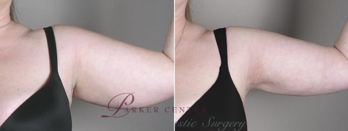 Upper Arm Rejuvenation Case 827 Before & After View #2 | Paramus, NJ | Parker Center for Plastic Surgery