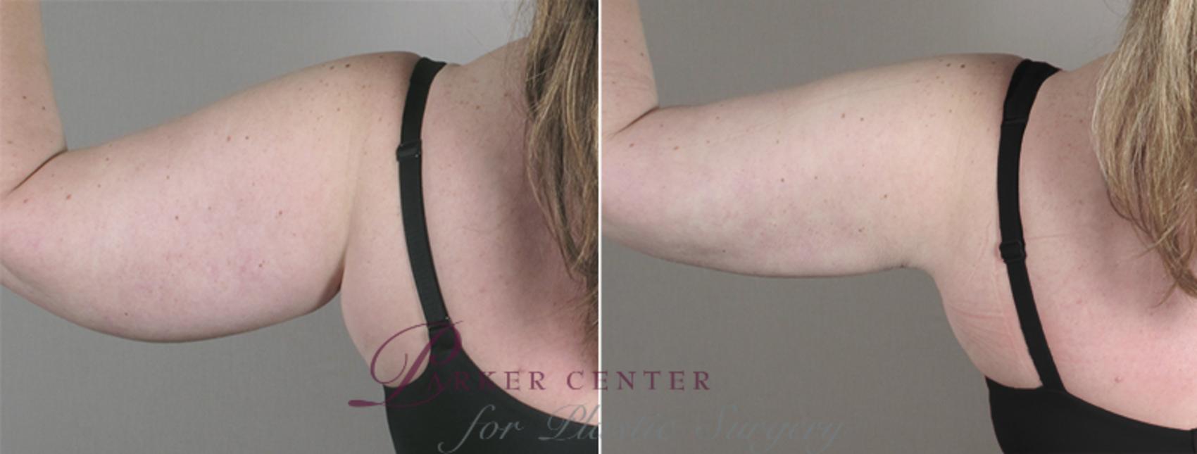 Upper Arm Rejuvenation Case 827 Before & After View #3 | Paramus, NJ | Parker Center for Plastic Surgery