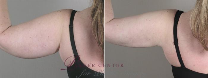 Upper Arm Rejuvenation Case 827 Before & After View #3 | Paramus, NJ | Parker Center for Plastic Surgery