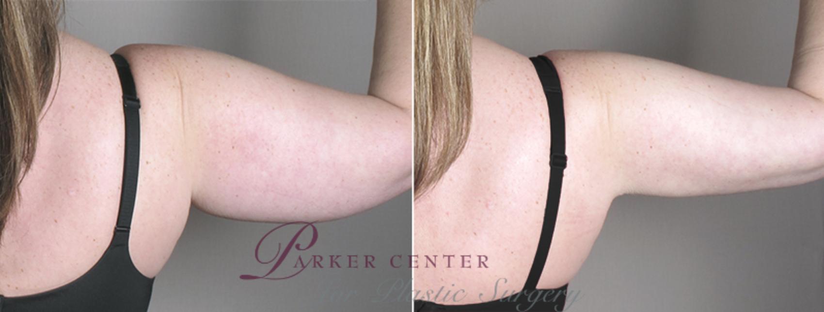 Upper Arm Rejuvenation Case 827 Before & After View #4 | Paramus, NJ | Parker Center for Plastic Surgery
