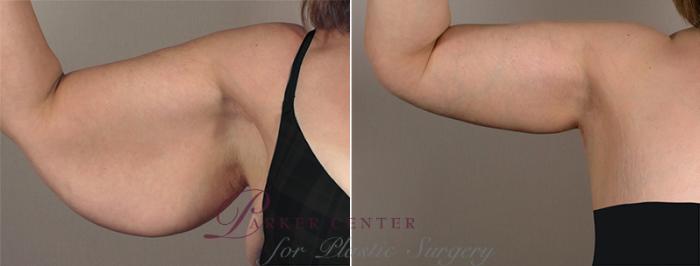 Upper Arm Rejuvenation Case 828 Before & After View #1 | Paramus, NJ | Parker Center for Plastic Surgery