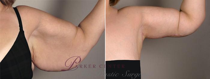Upper Arm Rejuvenation Case 828 Before & After View #2 | Paramus, NJ | Parker Center for Plastic Surgery