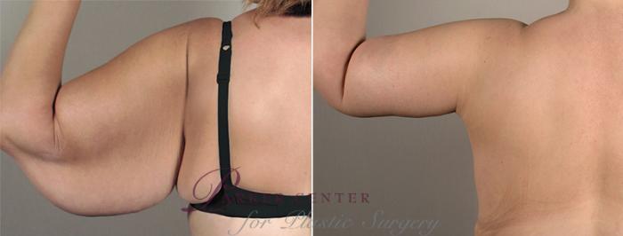 Upper Arm Rejuvenation Case 828 Before & After View #3 | Paramus, NJ | Parker Center for Plastic Surgery