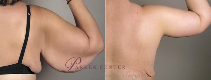Upper Arm Rejuvenation Case 828 Before & After View #4 | Paramus, NJ | Parker Center for Plastic Surgery