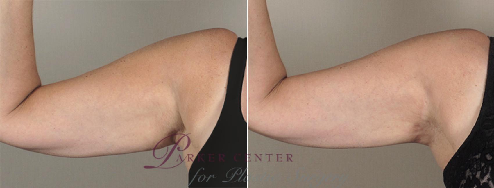 Upper Arm Rejuvenation Case 829 Before & After View #1 | Paramus, NJ | Parker Center for Plastic Surgery
