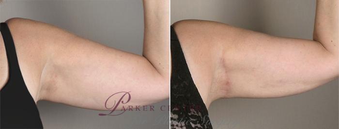 Upper Arm Rejuvenation Case 829 Before & After View #2 | Paramus, NJ | Parker Center for Plastic Surgery
