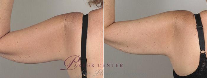 Upper Arm Rejuvenation Case 829 Before & After View #3 | Paramus, NJ | Parker Center for Plastic Surgery