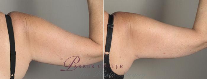 Upper Arm Rejuvenation Case 829 Before & After View #4 | Paramus, NJ | Parker Center for Plastic Surgery