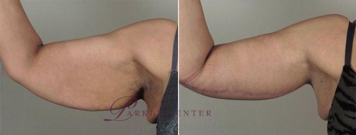 Upper Arm Rejuvenation Case 830 Before & After View #1 | Paramus, NJ | Parker Center for Plastic Surgery