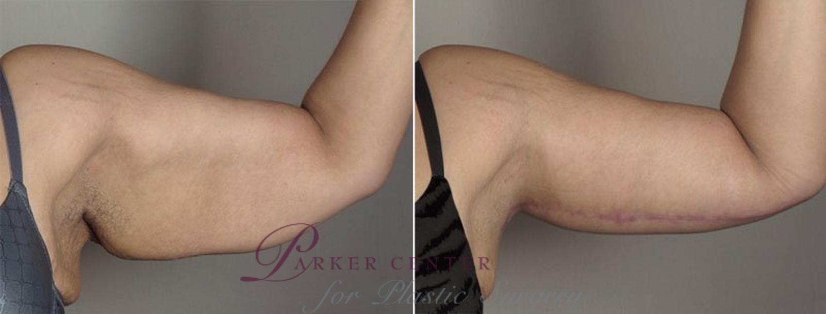 Upper Arm Rejuvenation Case 830 Before & After View #2 | Paramus, NJ | Parker Center for Plastic Surgery