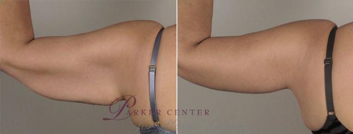 Upper Arm Rejuvenation Case 830 Before & After View #3 | Paramus, NJ | Parker Center for Plastic Surgery
