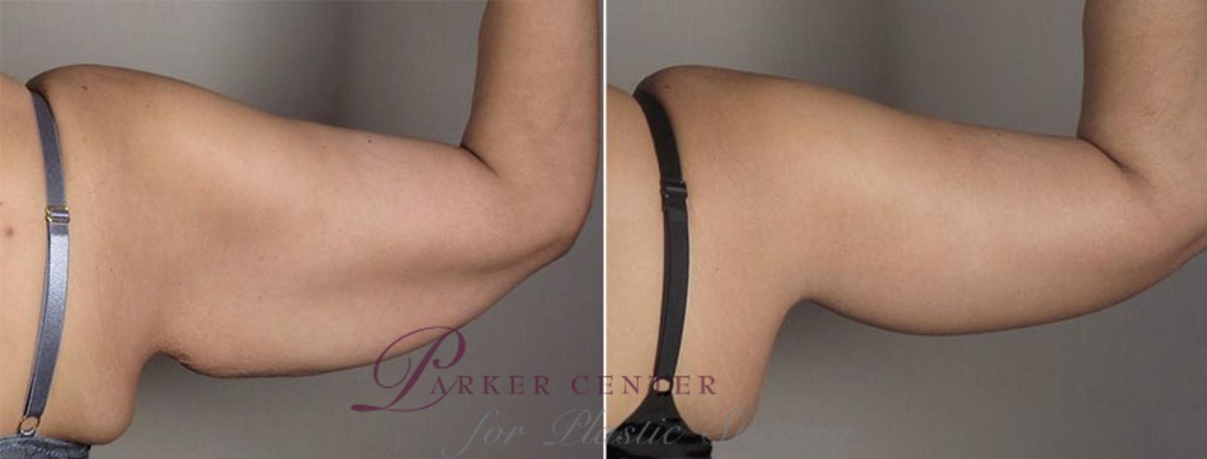 Upper Arm Rejuvenation Case 830 Before & After View #4 | Paramus, NJ | Parker Center for Plastic Surgery