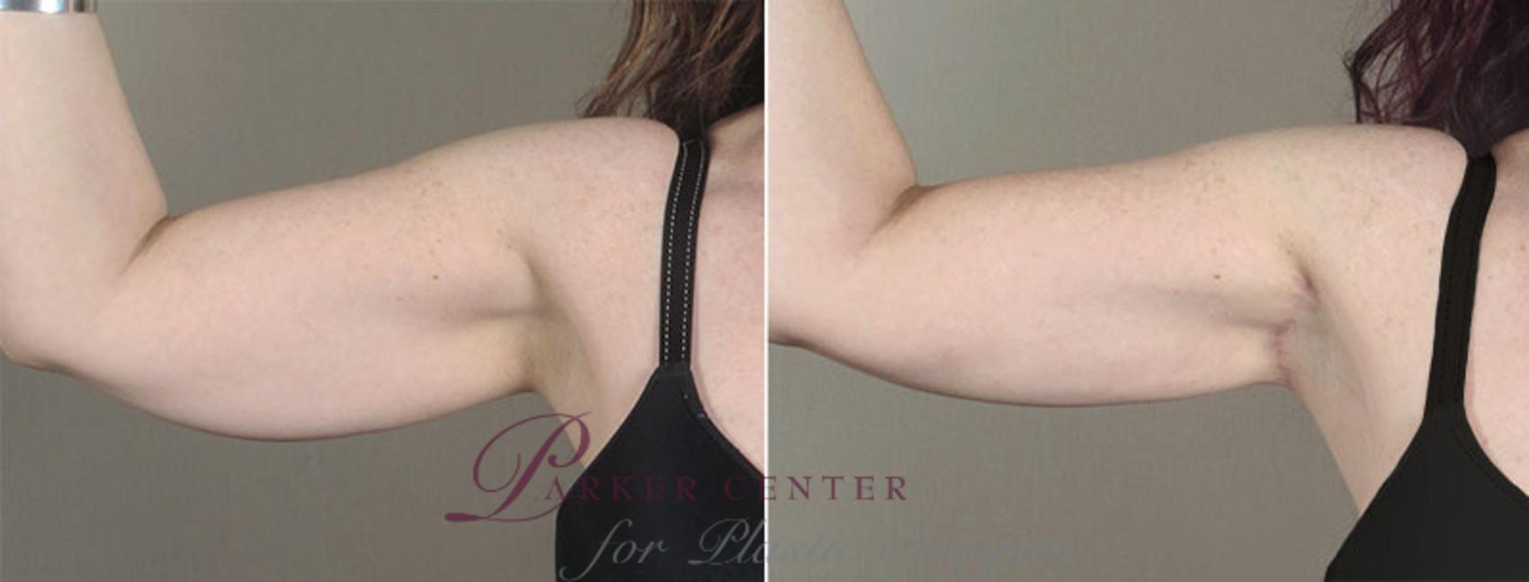 Upper Arm Rejuvenation Case 831 Before & After View #1 | Paramus, NJ | Parker Center for Plastic Surgery